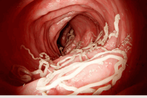 Ilustrasi cacingan/Science Photo Library